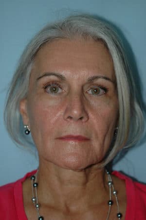 Face & Neck Lift Case 155 Before Photo Face & Neck Lift