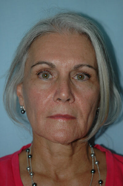 Face & Neck Lift