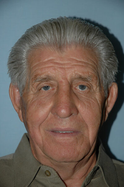 Rhinoplasty Case 237 After Photo Rhinoplasty