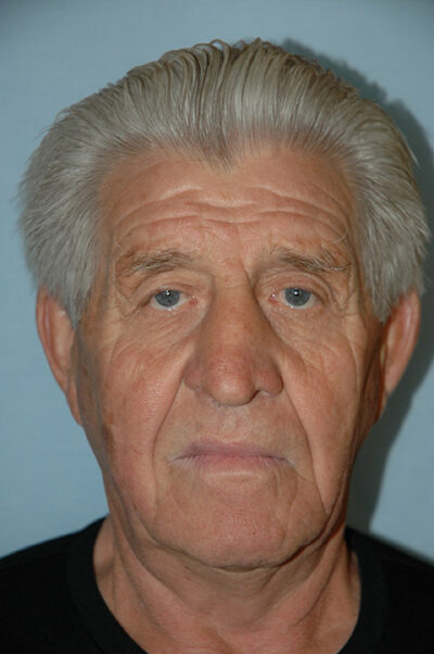 Rhinoplasty Case 237 Before Photo Rhinoplasty