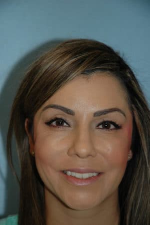 Rhinoplasty Case 240 After Photo Rhinoplasty