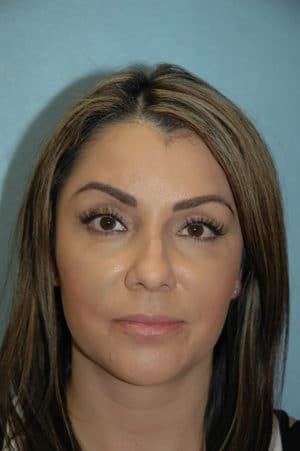 Rhinoplasty Case 240 Before Photo Rhinoplasty