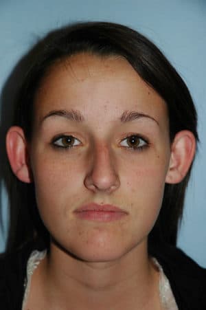Rhinoplasty Case 241 Before Photo Rhinoplasty