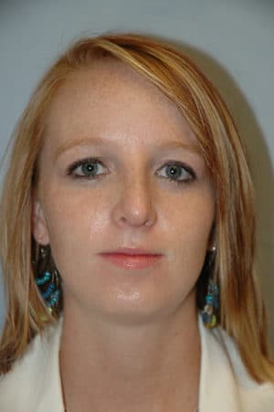Rhinoplasty Case 229 After Photo Rhinoplasty