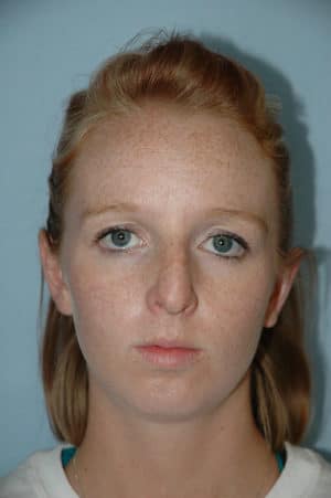 Rhinoplasty Case 229 Before Photo Rhinoplasty