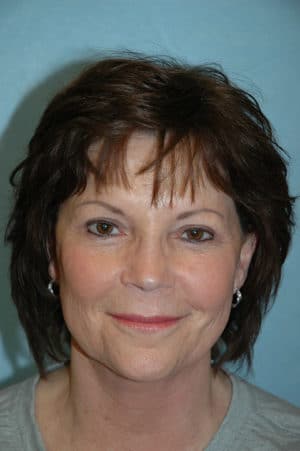 Face & Neck Lift Case 153 After Photo Face & Neck Lift