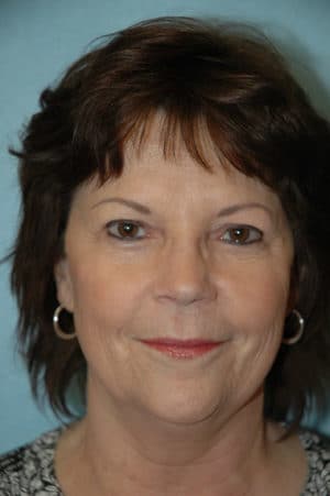 Face & Neck Lift Case 153 Before Photo Face & Neck Lift