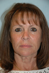 Face & Neck Lift