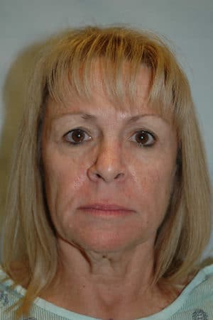 Face & Neck Lift Case 154 Before Photo Face & Neck Lift