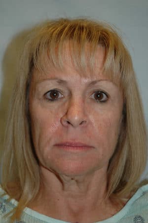 Face & Neck Lift