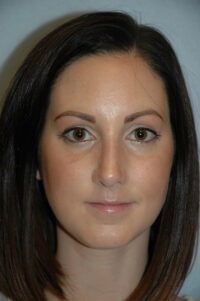 Rhinoplasty