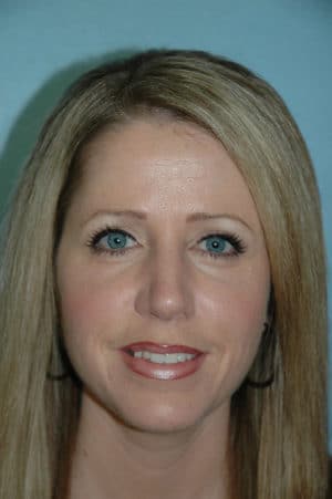 Rhinoplasty