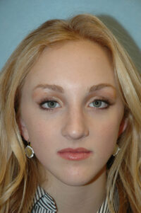 Rhinoplasty