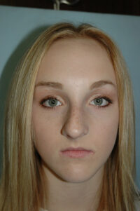 Rhinoplasty