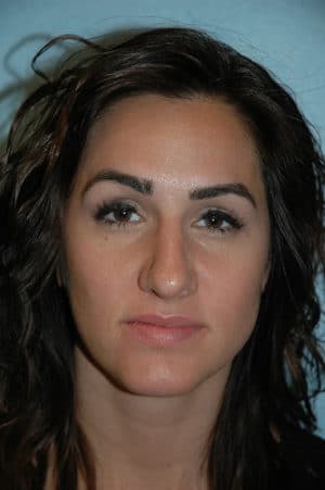 Rhinoplasty Case 234 After Photo Rhinoplasty