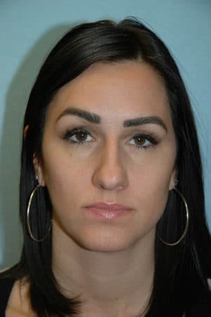 Rhinoplasty Case 234 Before Photo Rhinoplasty