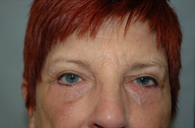 Blepharoplasty & Browlift