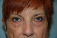 Blepharoplasty & Browlift