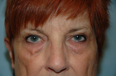 Blepharoplasty & Browlift