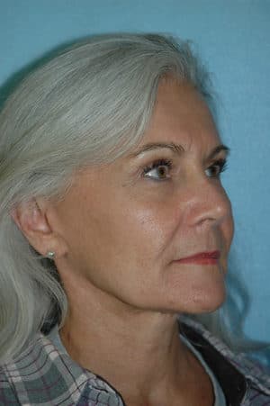 Face & Neck Lift Case 155 After Photo Face & Neck Lift