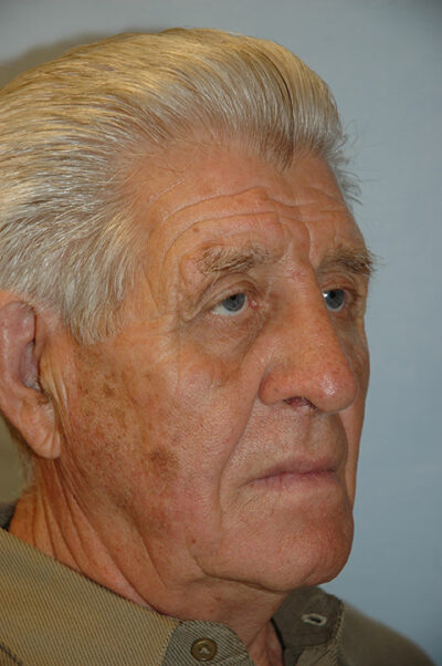 Rhinoplasty Case 237 After Photo Rhinoplasty