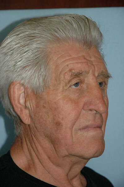 Rhinoplasty Case 237 Before Photo Rhinoplasty