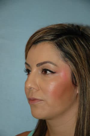 Rhinoplasty Case 240 After Photo Rhinoplasty