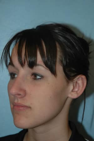 Rhinoplasty Case 241 After Photo Rhinoplasty
