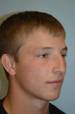 Rhinoplasty Case 235 Before Photo Rhinoplasty