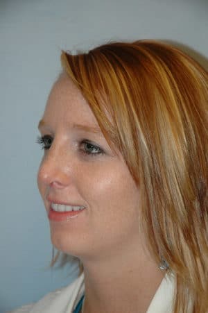 Rhinoplasty Case 229 After Photo Rhinoplasty