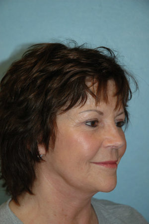 Neck Lift Results St. George