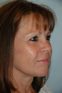 Face & Neck Lift