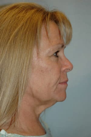 Face & Neck Lift Case 154 Before Photo Face & Neck Lift