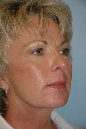 Face & Neck Lift