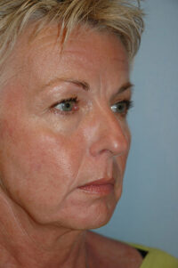 Face & Neck Lift