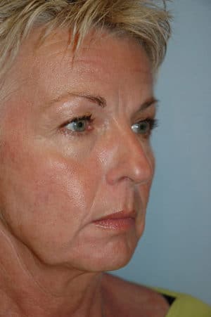 Face & Neck Lift