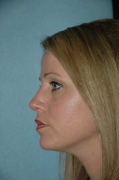 Rhinoplasty