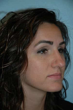 Rhinoplasty Case 234 After Photo Rhinoplasty
