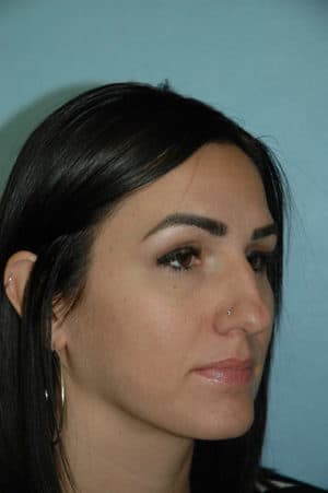 Rhinoplasty Case 234 Before Photo Rhinoplasty
