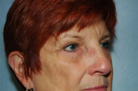 Blepharoplasty & Browlift