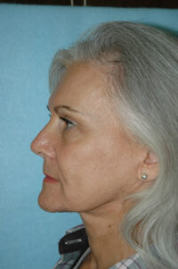 Face & Neck Lift
