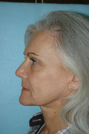 Face & Neck Lift Case 155 After Photo Face & Neck Lift