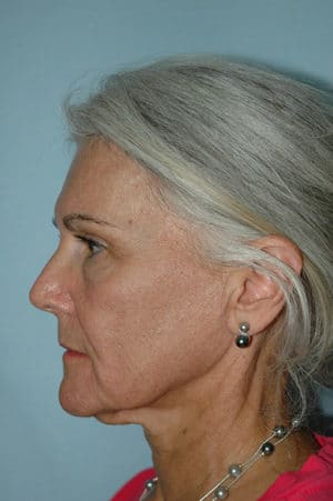 Face & Neck Lift Case 155 Before Photo Face & Neck Lift