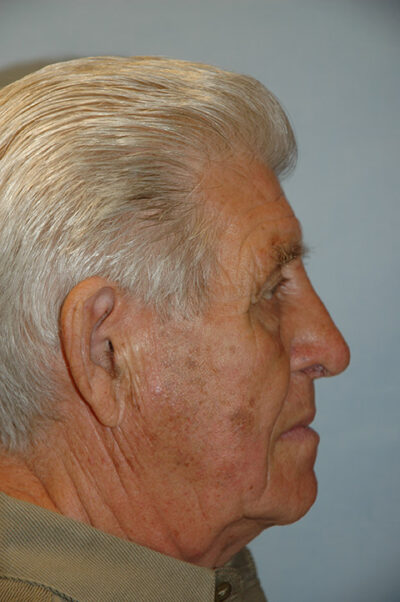 Rhinoplasty Case 237 After Photo Rhinoplasty