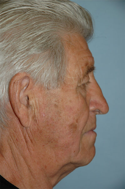 Rhinoplasty Case 237 Before Photo Rhinoplasty