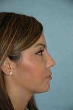 Rhinoplasty