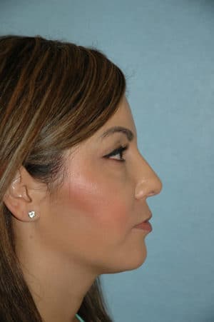 Rhinoplasty Case 240 After Photo Rhinoplasty