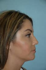 Rhinoplasty