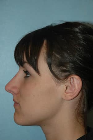Rhinoplasty Case 241 After Photo Rhinoplasty