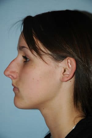 Rhinoplasty Case 241 Before Photo Rhinoplasty